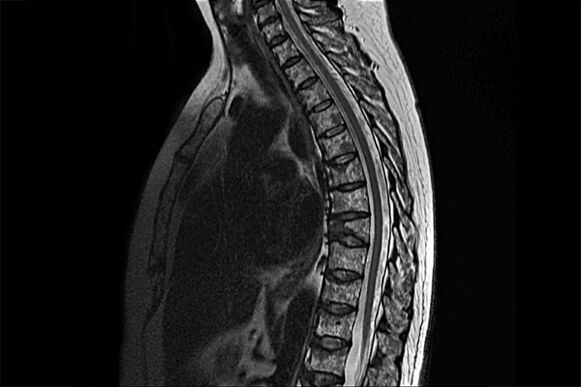 Manifestazioni di osteocondrosi toracica nell'immagine della risonanza magnetica