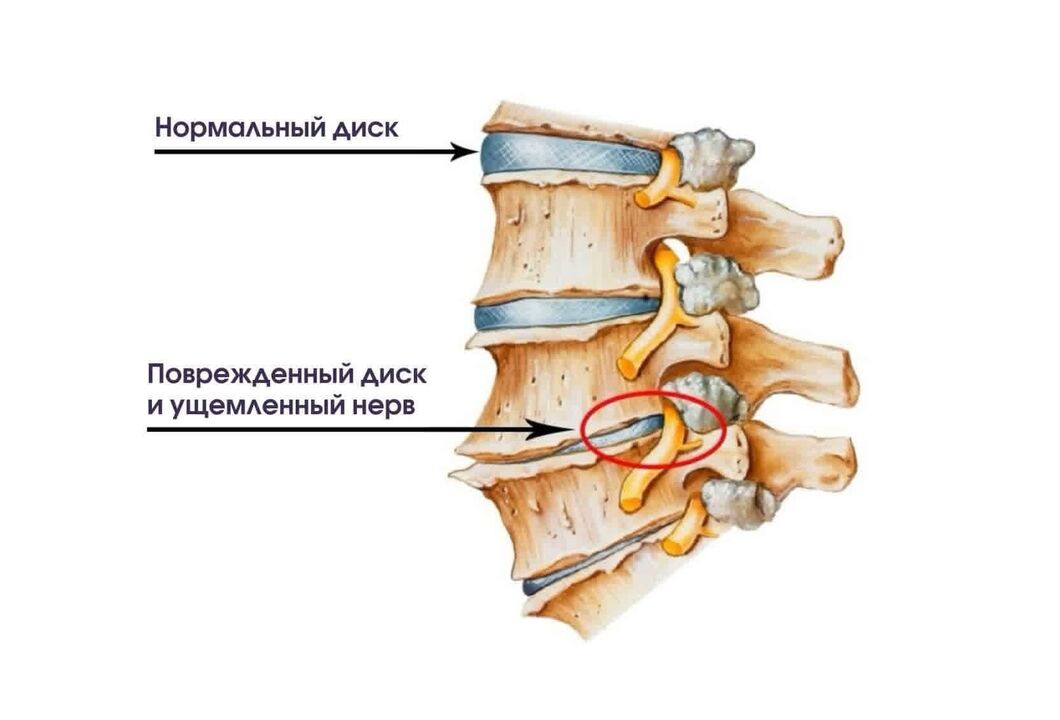 Sintomi di osteocondosi cervicale