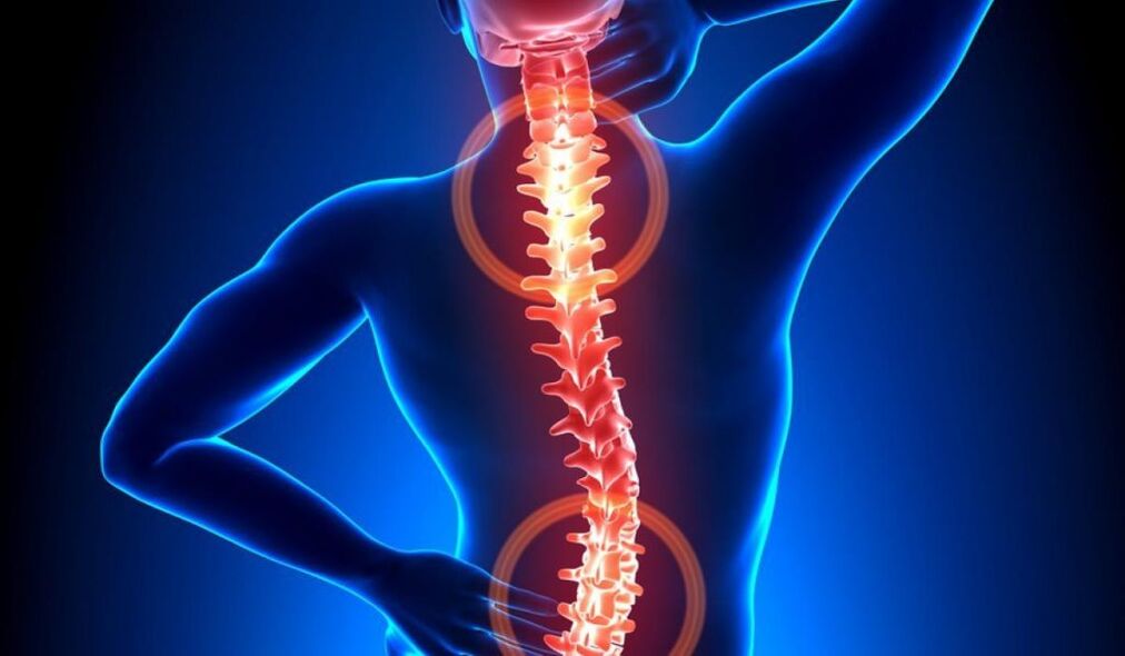 osteocondrosi spinale