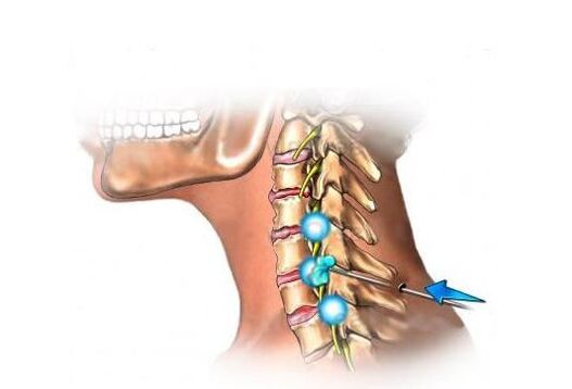 trattamento dell'osteocondrosi cervicale